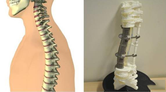 3D打印醫(yī)療應(yīng)用成功案例 北醫(yī)三院3D打印定制人工椎體植入術(shù)