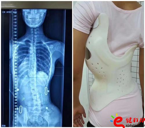 3D打印脊柱粒子導板