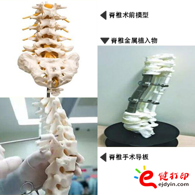 脊椎金屬植入物